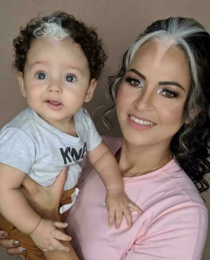 Mother And Child With Poliosis, A Hereditary White Streak In Their Hair