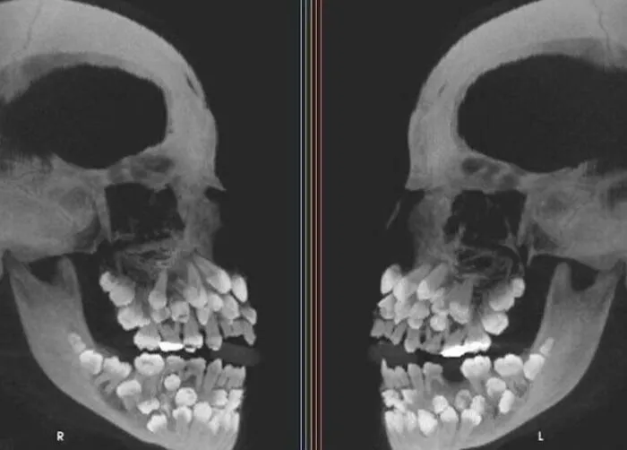 Una radiografía de una persona que tiene tres juegos completos de dientes