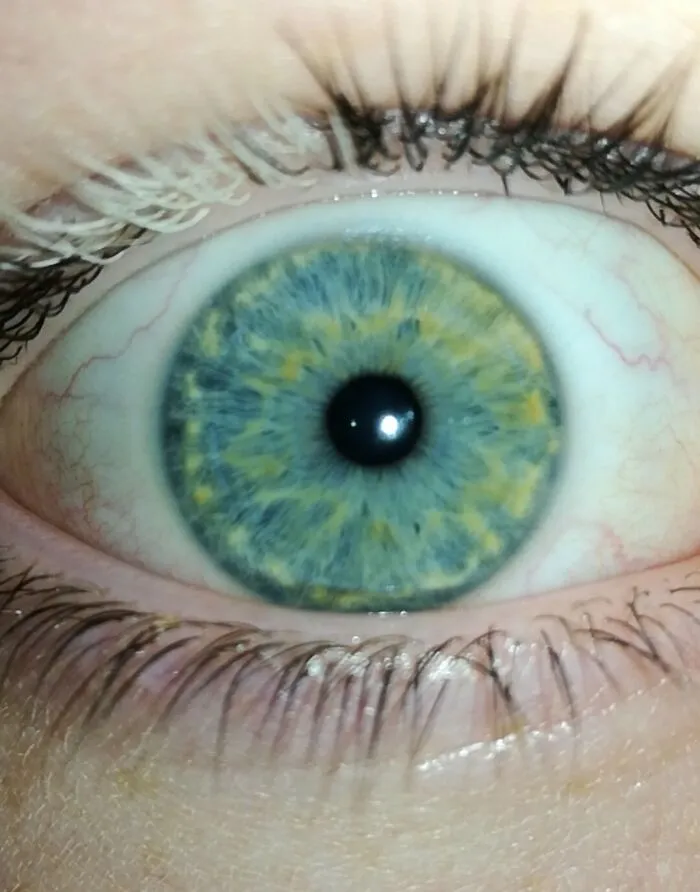 Mi ojo, tengo vitíligo, amarillo en el iris y una pupila ligeramente desplazada