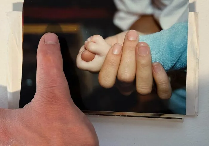 Nací con doble pulgar, pero me lo extirparon quirúrgicamente