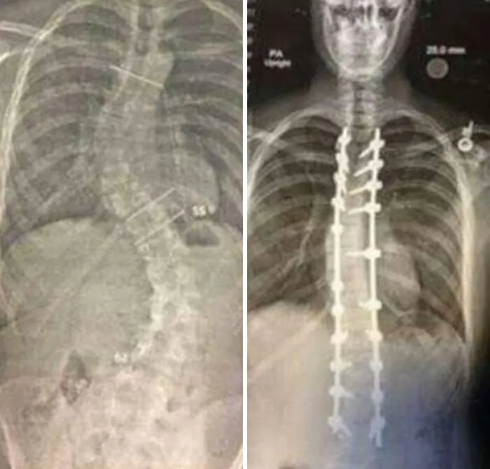 Estas son radiografías tomadas antes y después de la cirugía.