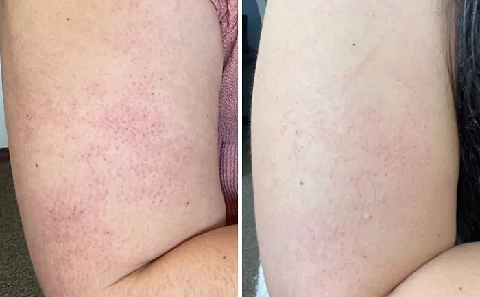 Those Stubborn Little Bumps On Your Arms And Legs Are Finally About To Meet Their Match With A Tub Of <a Style="Display:inline;" Href="Https://Www.amazon.com/First-Aid-Beauty-Eraser-Scrub/Dp/B07xg6bkcv?ie=utf8&th=1&linkcode=ll1&tag=bpsnail-20&linkid=7baebaa033067c9e9edefe1ed1e03d0e&language=en_us&ref_=as_li_ss_tl" Target="_blank"> <span Style="Font: Inherit;-Webkit-Font-Smoothing: Antialiased; Background-Color: Rgba(255, 255, 255, 0); Color: #d74b1f;"> Kp Bump Eraser Body Scrub </Span>