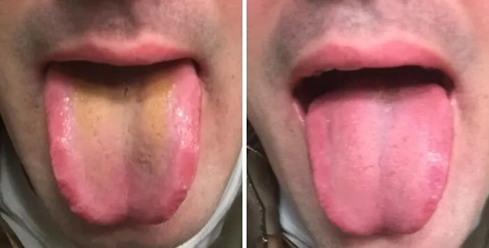 You Haven't Known True, Satisfying Disgust Until You've Seen What A <a Style="Display:inline;" Href="Https://Www.amazon.com/Dr-Tungs-Tongue-Cleaner-Stainless/Dp/B00064jgbo?ie=utf8&th=1&linkcode=ll1&tag=bpsnail-20&linkid=e93c89937b69a26cfb6f430996cd22b6&language=en_us&ref_=as_li_ss_tl" Target="_blank"> <span Style="Font: Inherit; Color: #d74b1f;"> Stainless Steel Tongue Scraper </Span> Can Excavate From Your Mouth First Thing In The Morning