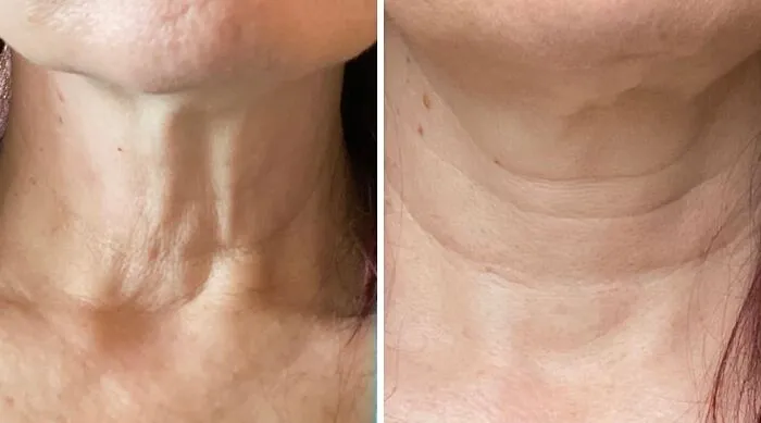 Your Skincare Routine Has Your Face Looking Like It Just Time-Traveled From 2012, But Your Neck Is Being A Real Tattletale; Time To Get Them On The Same Page With Some <a Style="Display:inline;" Href="Https://Www.amazon.com/Gold-Bond-Moisturizing-Salicylic-Hydration/Dp/B01b5d3voc/Ref=cm_cr_srp_d_product_top?ie=utf8&th=1" Target="_blank"> <span Style="Font: Inherit; Color: #d74b1f;"> Neck And Chest Skin Firming Cream </Span>