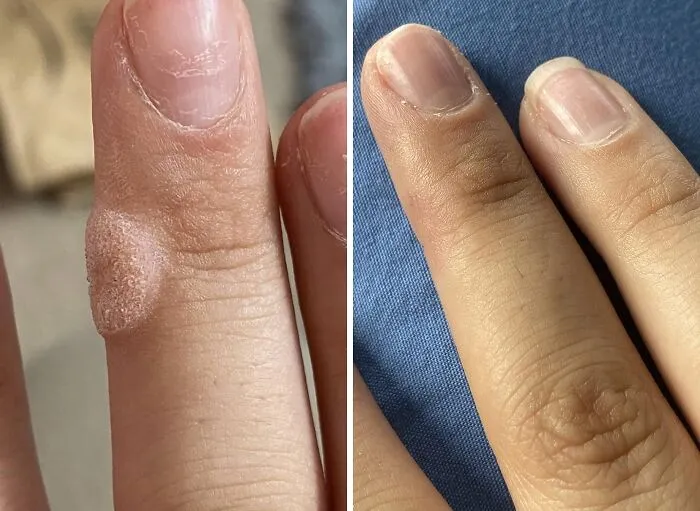 That Unwelcome Little Squatter That's Been Living Rent-Free On Your Finger Is About To Get Served An Eviction Notice, Courtesy Of <a Style="Display:inline;" Href="Https://Www.amazon.com/Compound-Step-Pads-Salicylic-Remover/Dp/B000qwlozw?ie=utf8&th=1&linkcode=ll1&tag=bpsnail-20&linkid=b2d943c45e91268cc5deee4cf31a6303&language=en_us&ref_=as_li_ss_tl" Target="_blank"> <span Style="Font: Inherit; Color: #d74b1f;"> Compound W Wart Remover </Span>