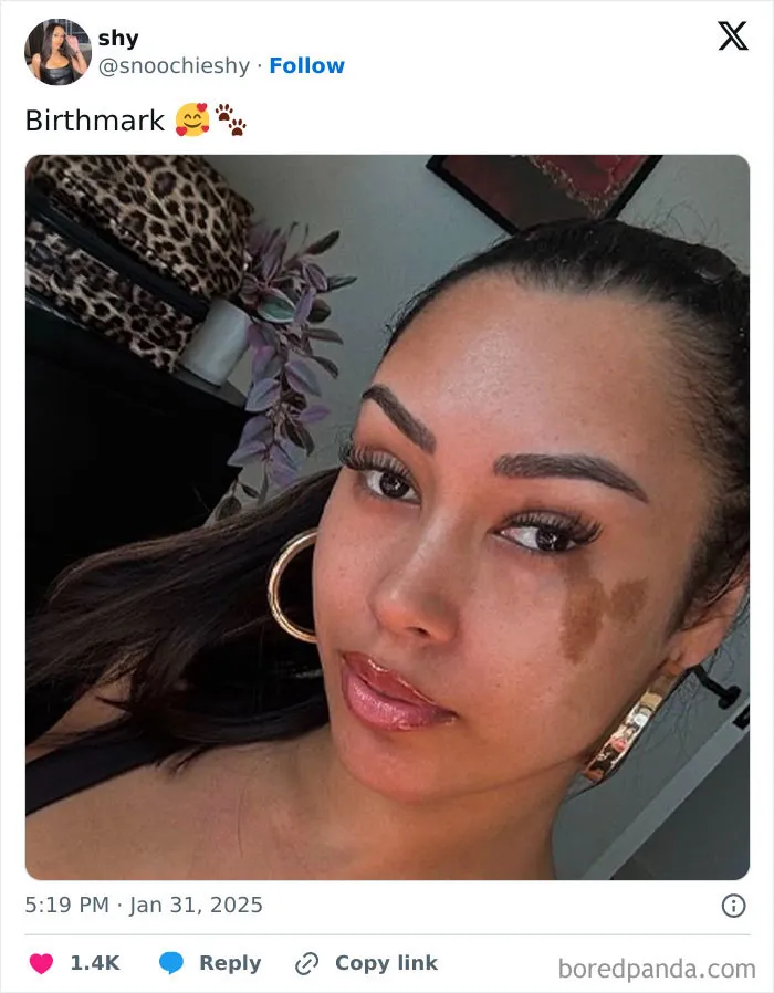 You Are Beautiful With The Birthmark