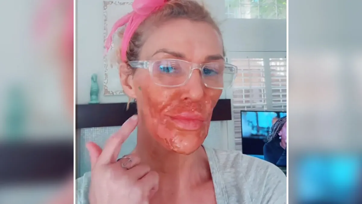 Brandi Glanville Chemically Burns Her Face Desperately Trying To Remove 'Parasite'
