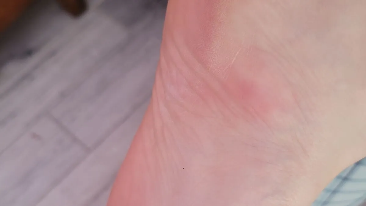 Hey Pandas, What Was The Worst Place You've Gotten Bitten By A Bug Or Insect