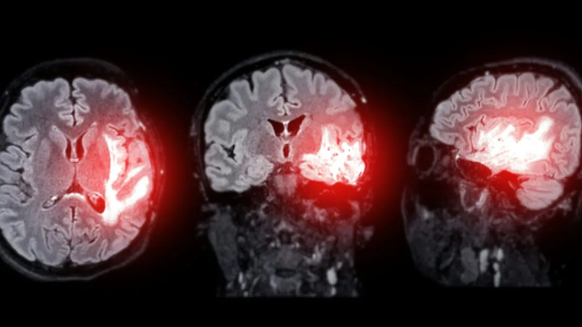 Neurologist Warns Against Popular Post-Exercise Habit That Could Trigger Strokes And Dementia