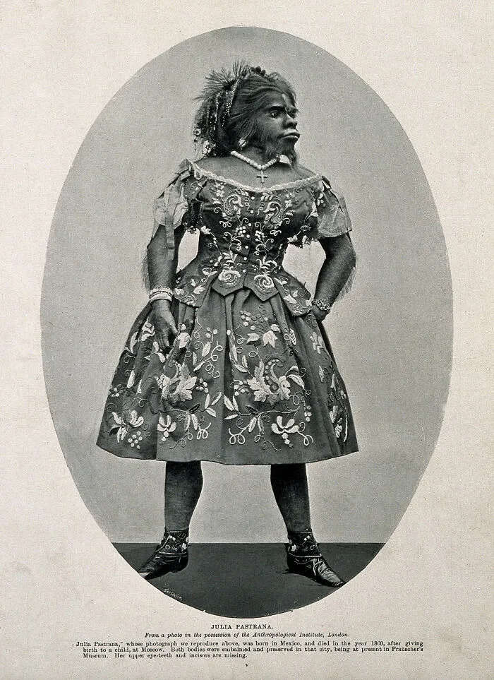 A Woman Suffering From Two Rare Conditions 