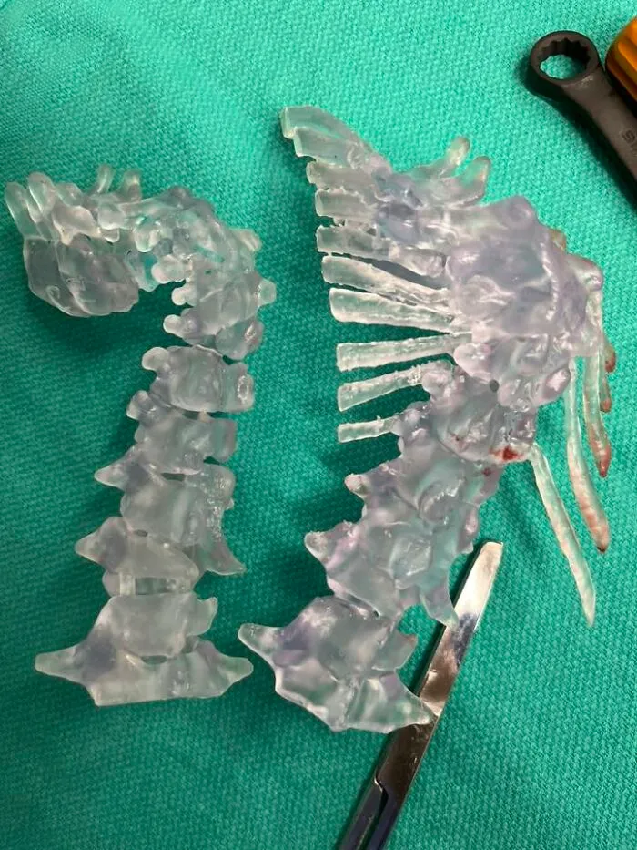 3D Printed Spine We Used In Surgery
