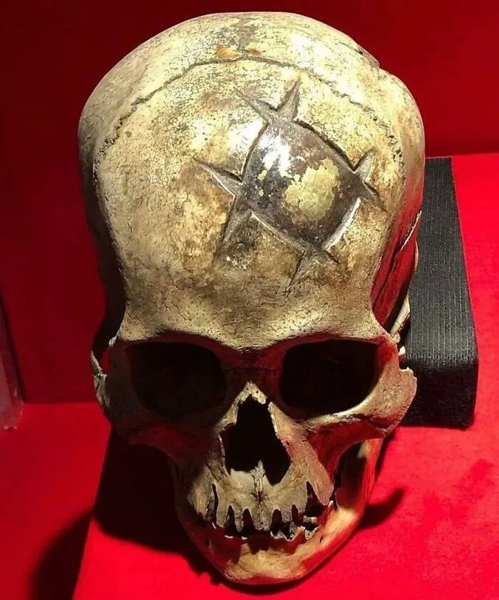 Un ejemplo temprano de craneoplastia exitosa (Perú, 400 d. C. aprox). El paciente sobrevivió, como lo demuestra la craneoplastia in situ, bien curada y realizada con una incrustación de oro.