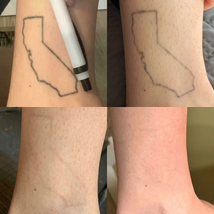 Faded outline tattoo of California gradually removed from skin in a series of before and after photos.