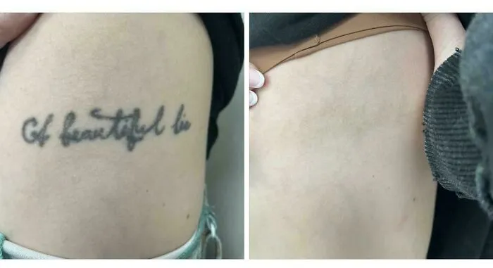 Faded tattoo error on skin showing removal results, demonstrating tattoo mistakes are not permanent anymore.