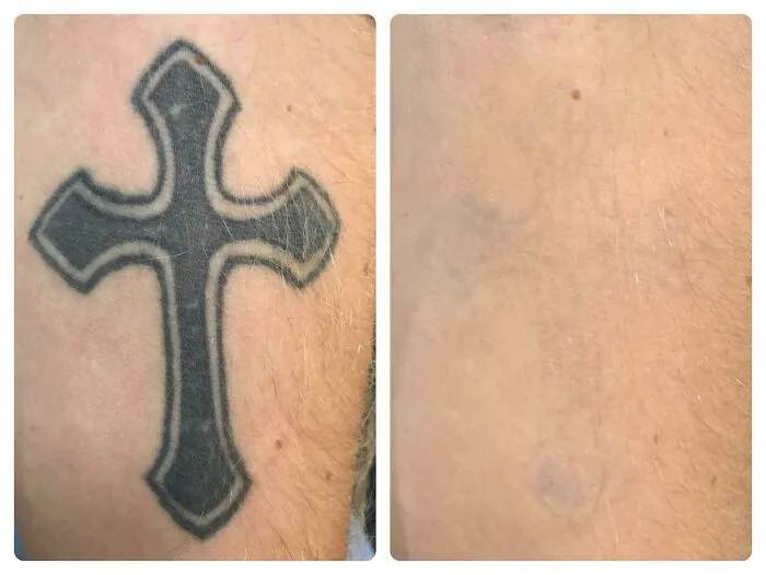 Before and after photo showing successful removal of a black cross tattoo, highlighting tattoo mistake correction results.