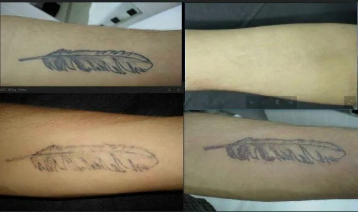 Before and after photos showing tattoo mistakes fading and skin healing, illustrating tattoo correction progress on forearms.