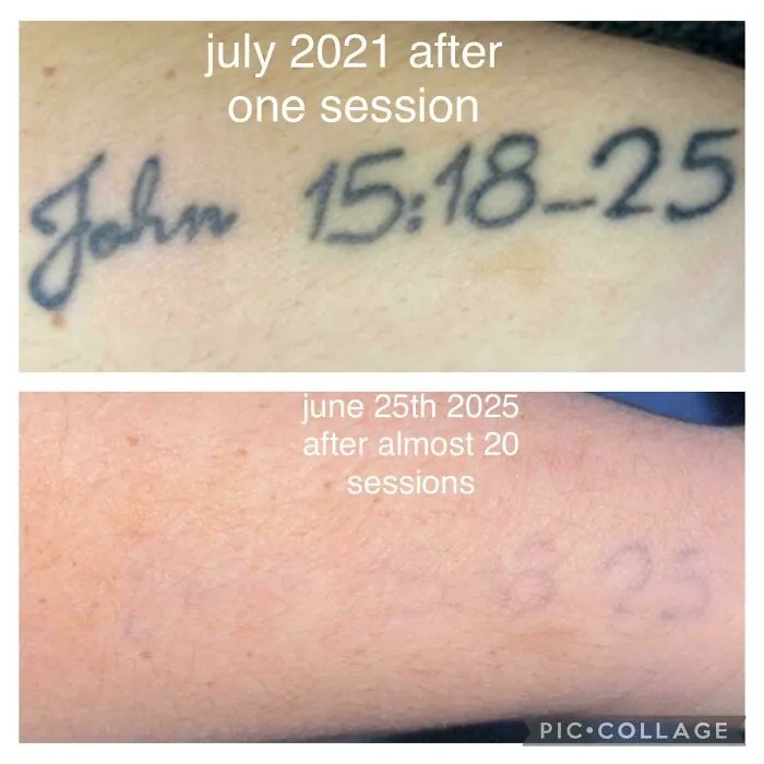 Faded tattoo after multiple sessions showing how tattoo mistakes can be removed over time.