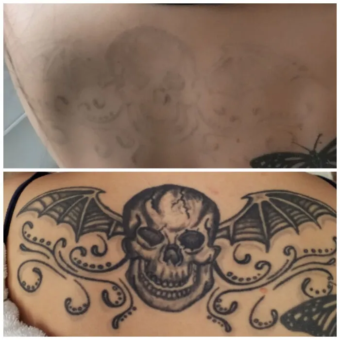 He tenido seis tratamientos en dos años. ¡Estoy muy contenta con el progreso!