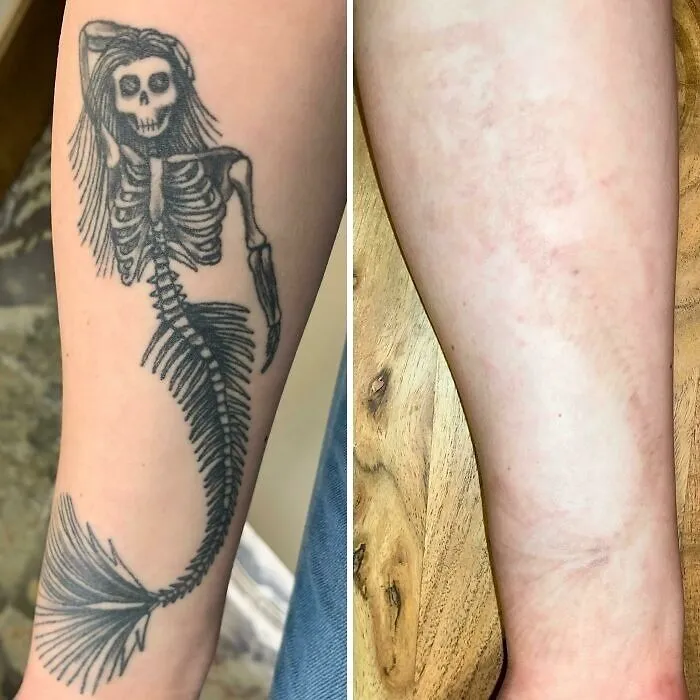 Tattoo mistake on forearm before and after removal, showing faded skin and clear improvement in tattoo correction.