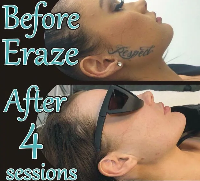 Ok Guys Please Don’t Judge🤦🏻♀️ I Just Wanted To Show You The Benefits Of Leaving A Huge Gap In Between Sessions, So This Is Only 4 Sessions Of Removal With Pico Laser, 1 Each 12 Months, It Just Kept Continuing To Fade On It’s Own , Stoked With The Results !!!