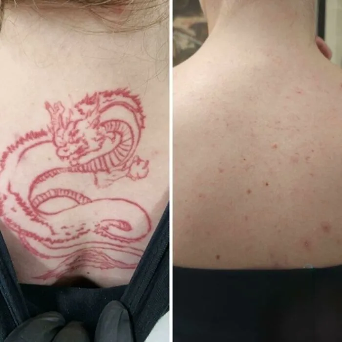 Before and after photos showing fading of a red dragon tattoo, highlighting how tattoo mistakes aren’t permanent anymore.