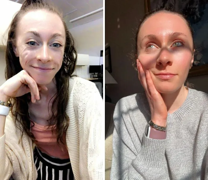 Around A Year Between These Photos. It Took Months In A Treatment Center, Three Relapses And Two More Near Death Experiences But I’ve Been Recovering From Anorexia On My Own