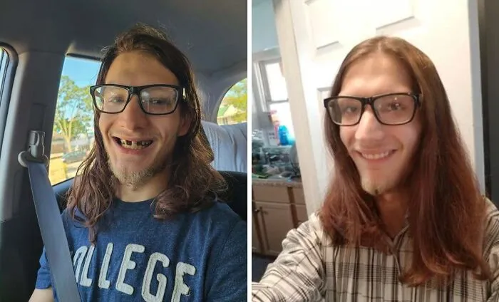 After Years Of Tooth Pain And Hiding My Smile, I Got Dentures! They Literally Mademesmile!