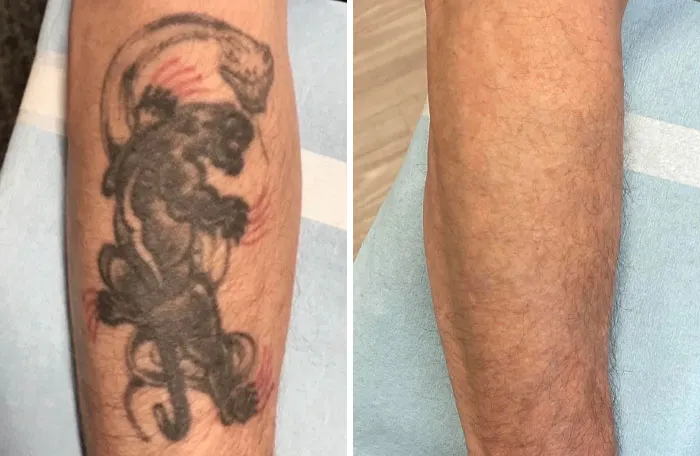 Before and after photos showing tattoo mistakes on a forearm that have been successfully removed and corrected.