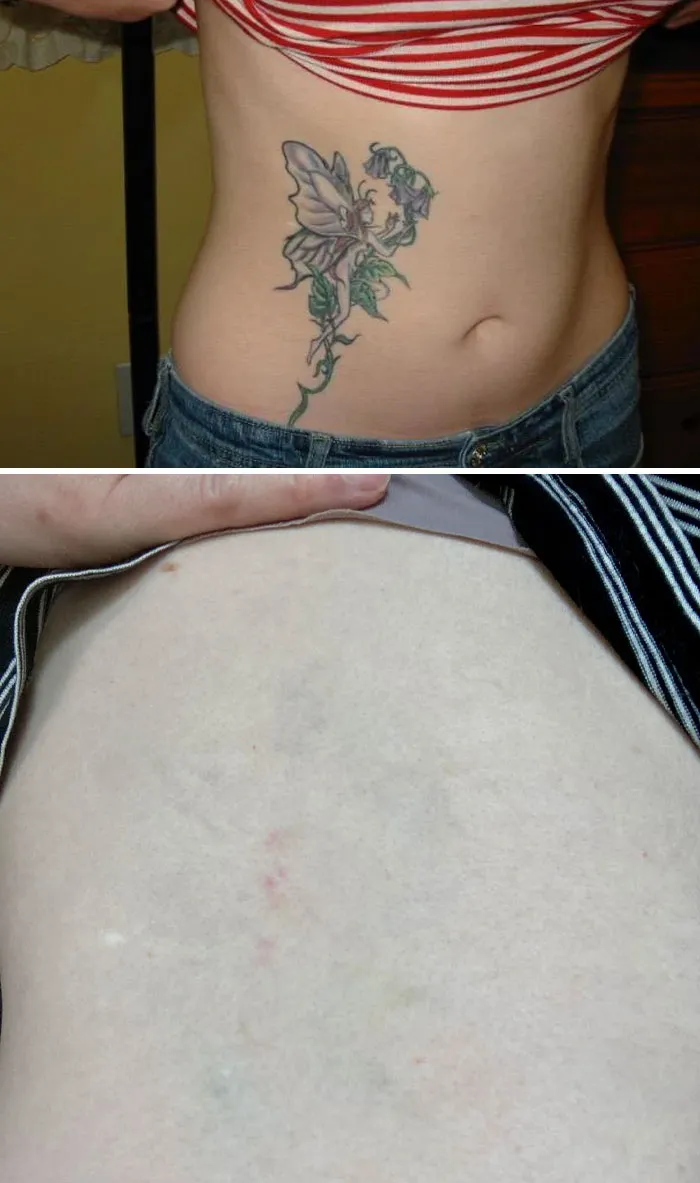 Before and after photos showing tattoo mistakes removed from skin, highlighting advances in tattoo mistake correction.