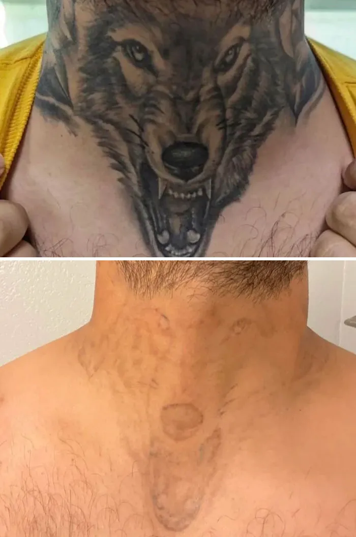 Actualización sobre la eliminación de mi tatuaje