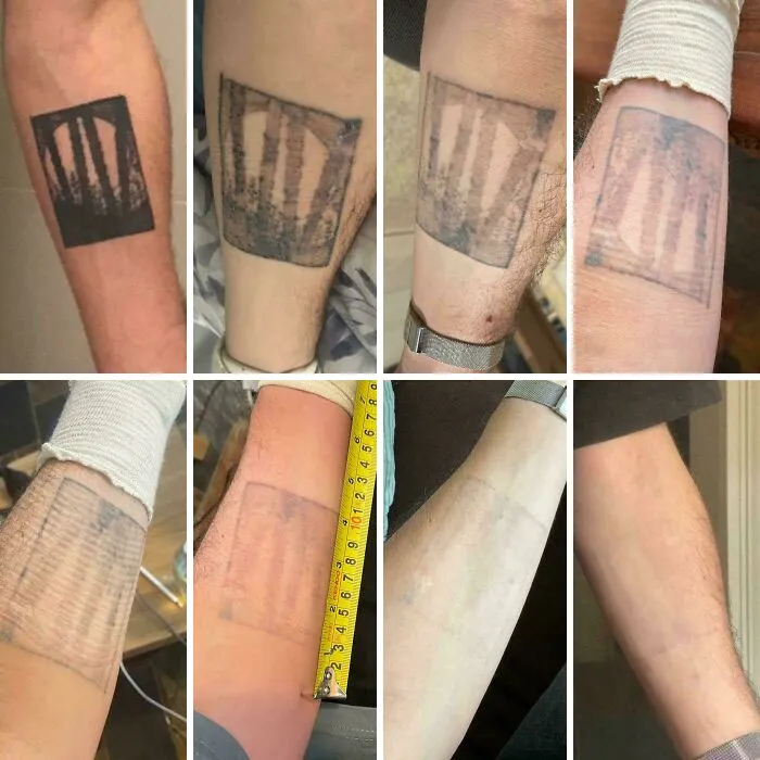 Fading tattoo removal process shown in eight before and after photos on a person's forearm.