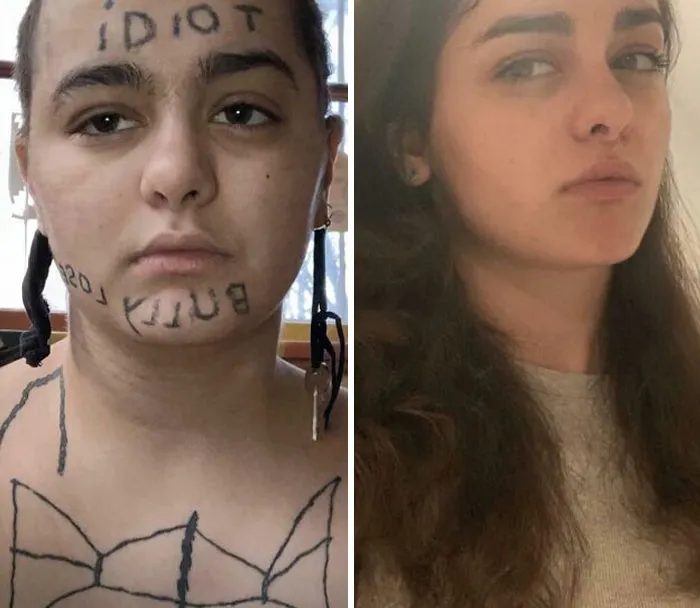 Para castigarme por una crisis nerviosa hace unos años, me tatué la cara. Con pico láser lo eliminé en 4 sesiones. 