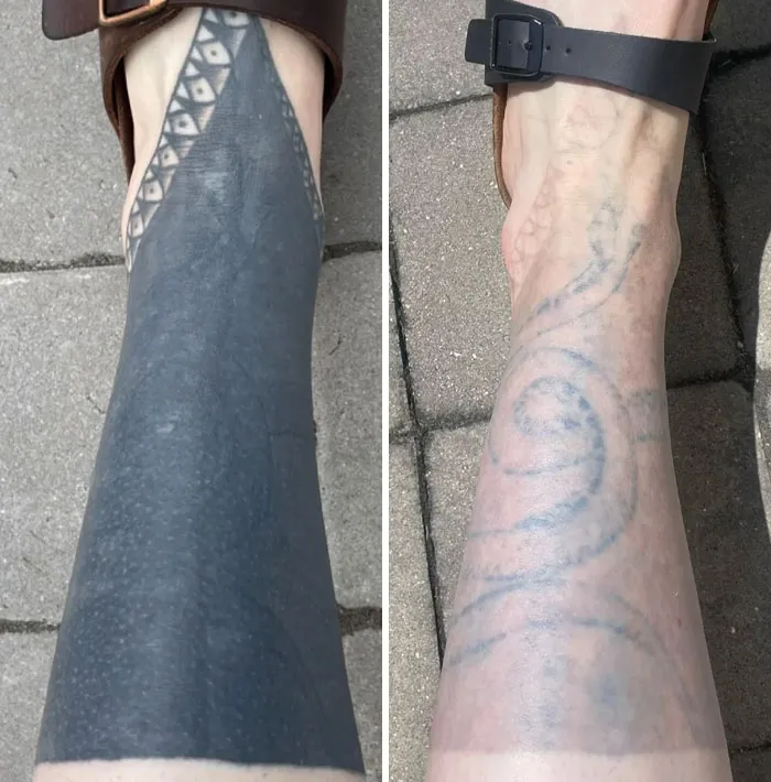 2,5 años de progreso en la eliminación de tatuaje todo negro