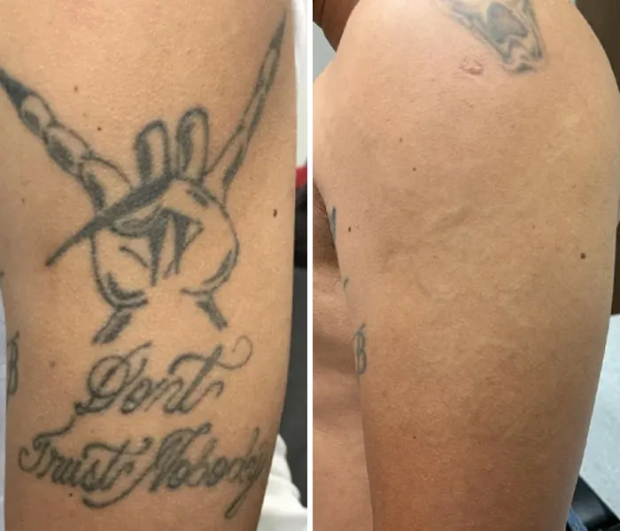 Five Sessions Over A 4 Year Period. Q Switch Nanosecond Laser. Not Picoway. Not Removery