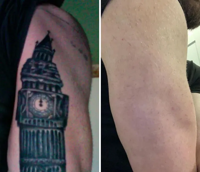 Un enorme tatuaje negro que se había rehecho dos veces antes de decidir eliminarlo. Dos años y unas diez sesiones después, desapareció.