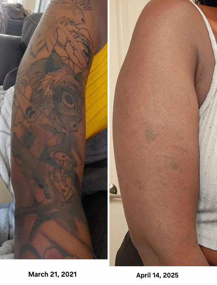 Before and after photos showing tattoo mistakes fading and skin healing over years with tattoo removal progress on arm.