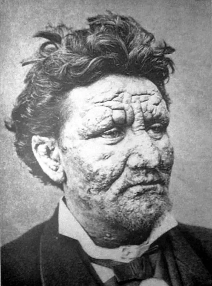 42 Rare Diseases That Sound Like A Science Fiction Plot But Are 100% Real
