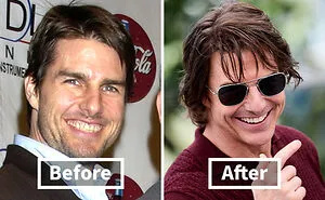 Veneers Before And After: Photos Of 15 Celebrities With The Most Dramatic Smile Makeover