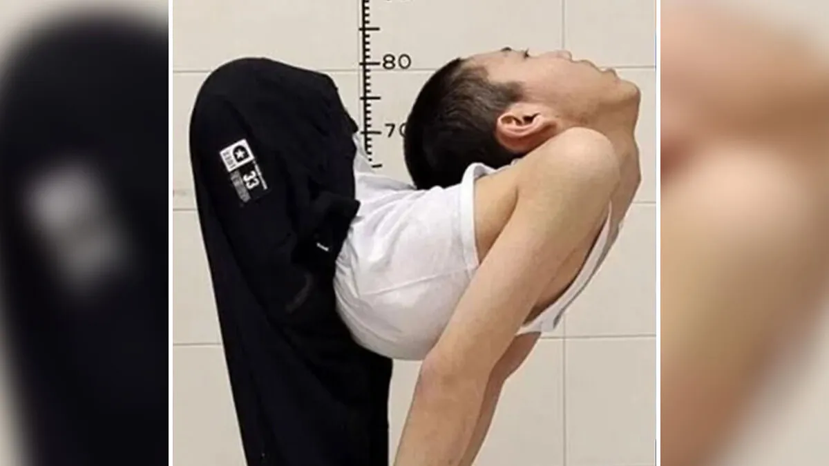 'Folded Boy' Who Was Bent At 180 Degrees For Most Of His Life Stuns With 'Magical' Transformation