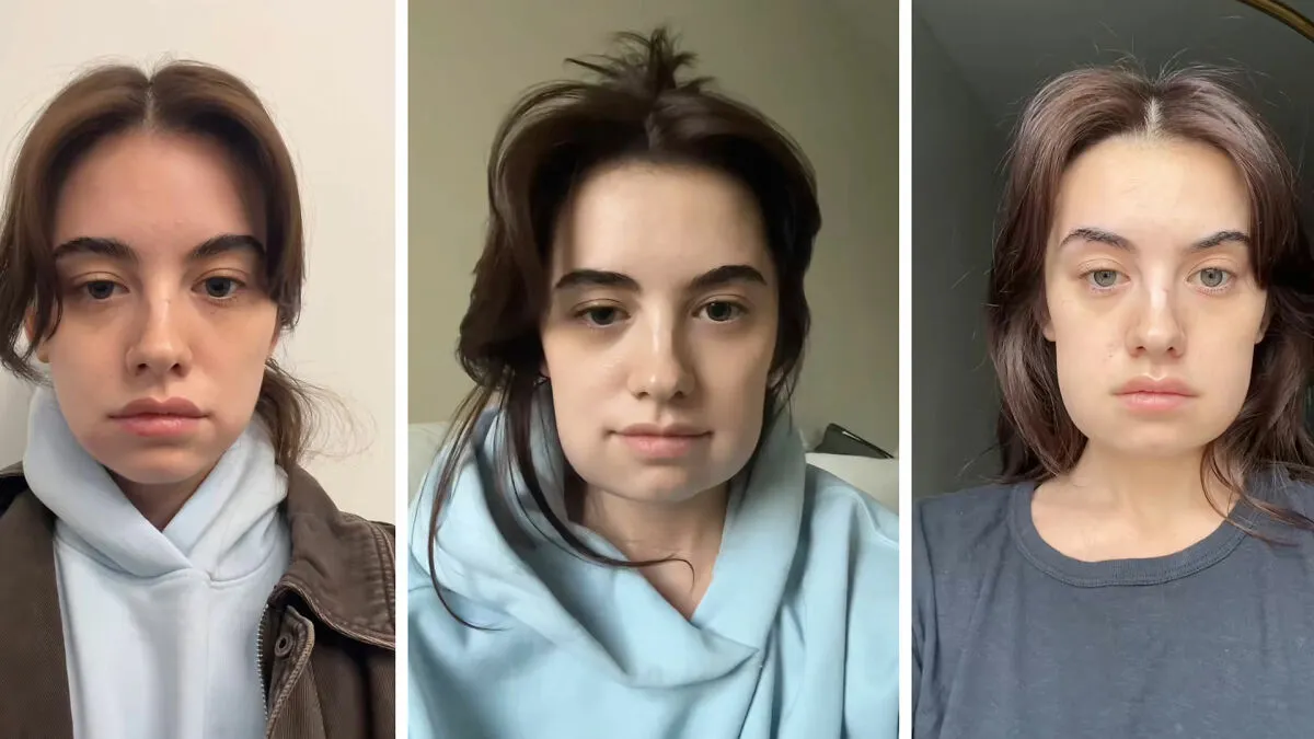 Woman's 'Kybella' Face Transformation Stuns People After Her Extreme Recovery Phase Goes Viral