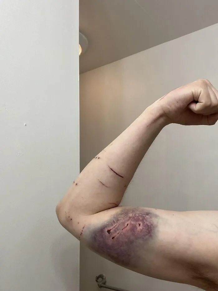 Brazo con moretón grande y cortes visibles que muestran consecuencias peligrosas sin darse cuenta del riesgo.