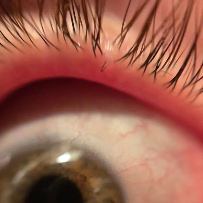 A pesar de haber consultado a varios médicos, mi ojo lagrimeó excesivamente durante 7 años hasta que me tomé esta foto.