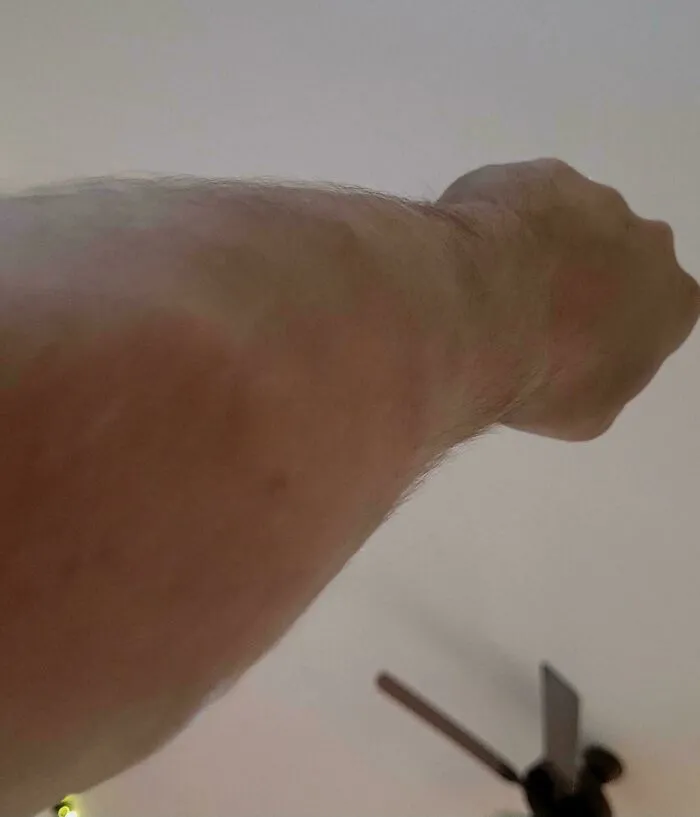 I Have Over A 100 Lipomas On Me And My New Dermatologist Wants To Treat Them As Cosmetic Which Means Insurance Won't Cover Them