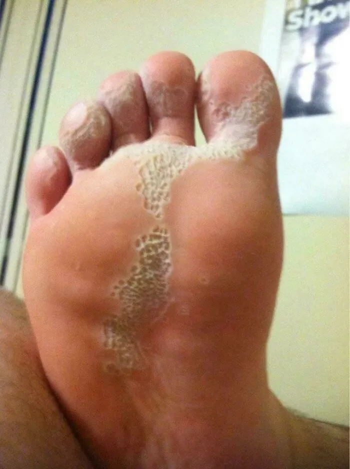 This Is Some Type Of Bacterial Foot Thing 🫣