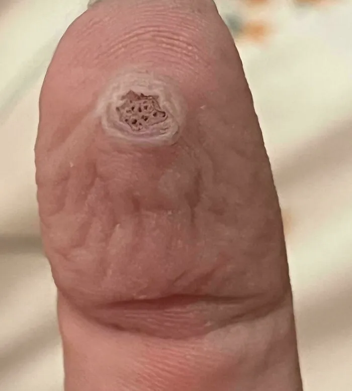 Close-up of a finger tip with textured holes, an unsettling image triggering trypophobia sensations.