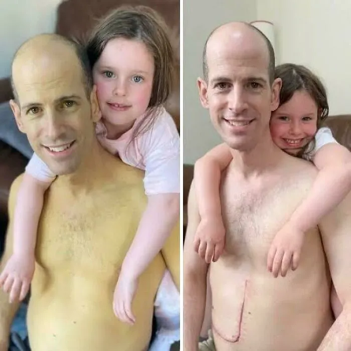 A Dad Who Underwent A Liver Transplant, Taken Just Six Weeks Apart