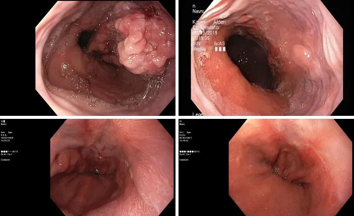 ¿Alguna vez te has preguntado cómo luce un tumor (de esófago)? Tras 7 sesiones de quimioterapia, este es el progreso.