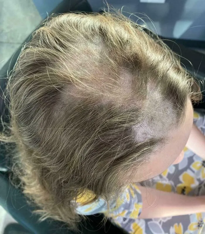 Necesito ayuda. Mi sobrina se puso crema depilatoria en la cabeza por accidente. ¿Qué se puede hacer para disimularlo o minimizar su impacto?