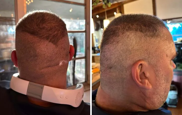 Hombre con corte de cabello irregular y parches visibles, mostrando accidentes capilares graciosos y trágicos.