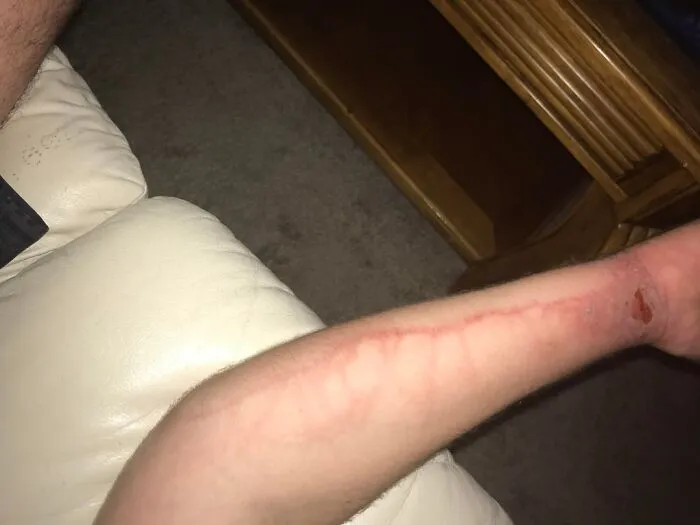 Mi novia dijo que tal vez os interese ver cómo se ve una infección por hiedra venenosa